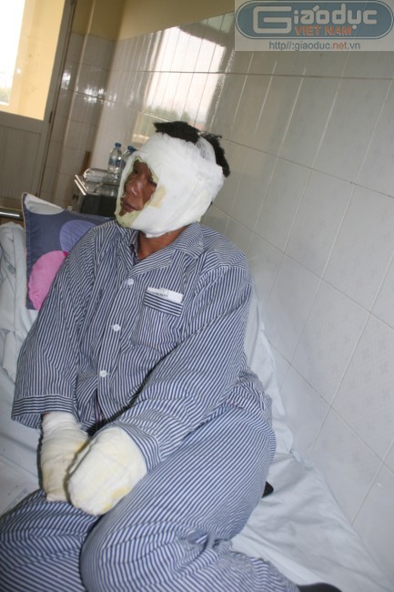 Anh Trần Văn Tuấn bị bỏng nặng đường hô hấp